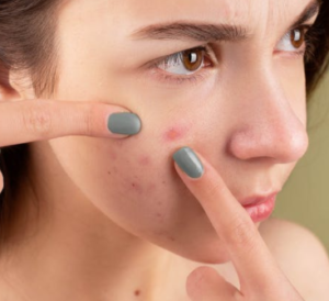 Akne odnos, ki bi morali ostati jasno, da zmanjša videz acnes na obrazu